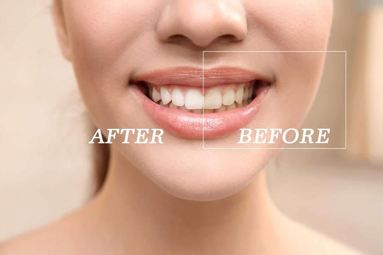 What Are the Most Effective Natural Teeth Whitening Methods You Can Try Hemel?