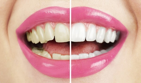 What Early Signs of Oral Cancer Should You Never Ignore Hemel?