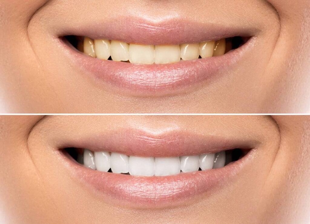 How Does Gum Disease Progress if Left Untreated Hemel?