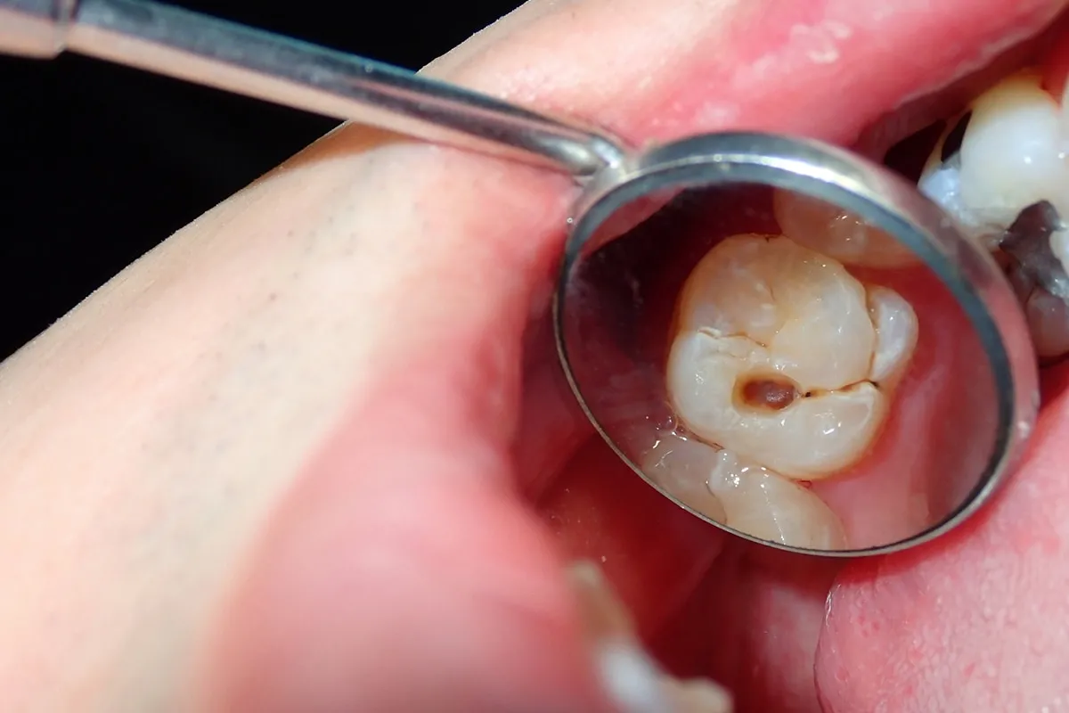Why Do Teeth Crack? Common Causes to Know Hemel