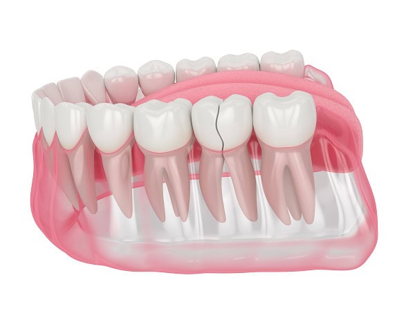 How Can You Manage Pain and Discomfort After a Root Canal Hemel?