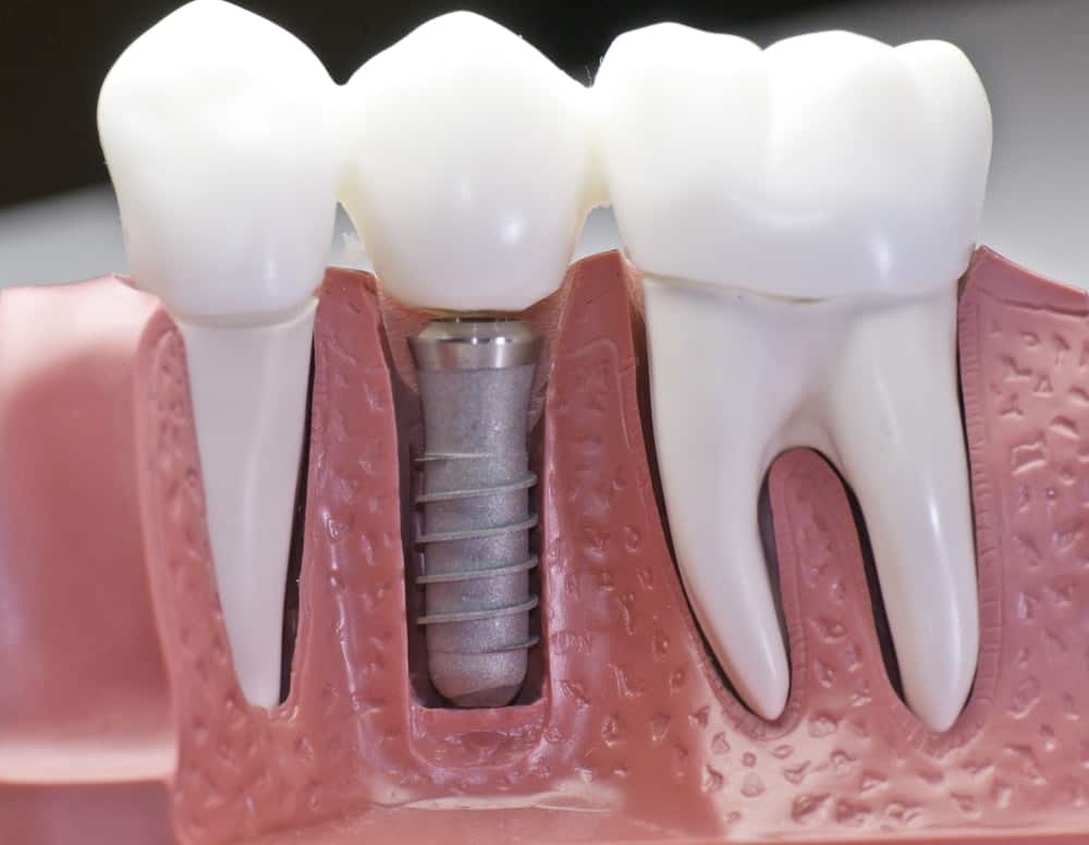 Common Misconceptions About Modern Dental Treatments Hemel