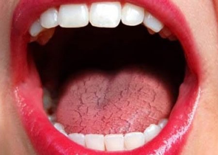 Common Causes of Dry Mouth (Xerostomia) Hemel