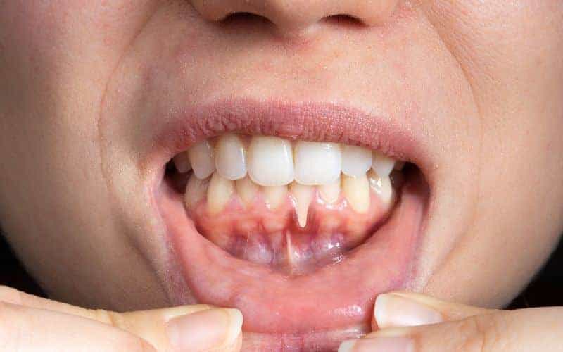 How Can Gum Disease Be Prevented Hemel?