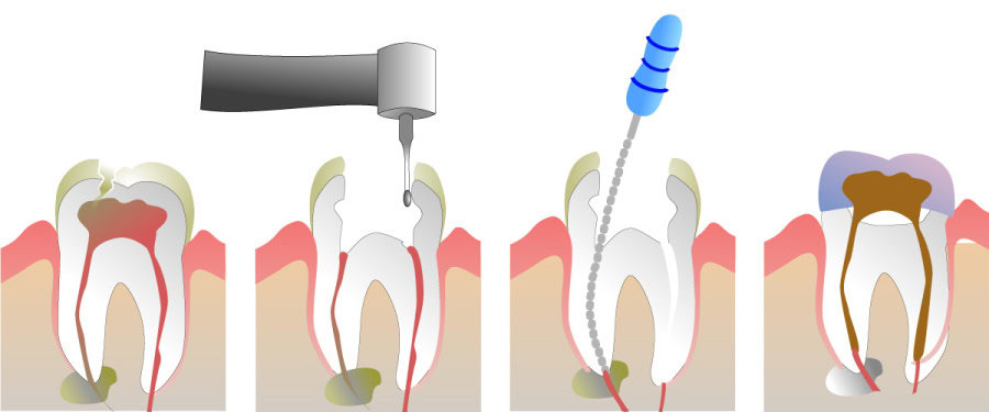 How Do You Properly Care for Your Teeth After a Root Canal Hemel