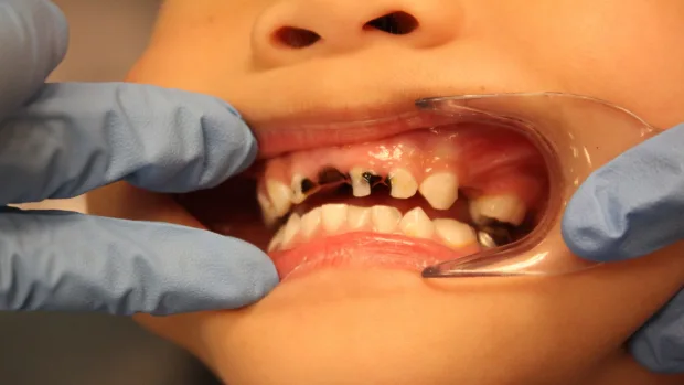 Which Foods and Drinks Cause the Most Damage to Young Smiles Hemel?