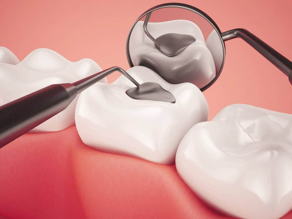 Fighting Cavities and Plaque Buildup Hemel