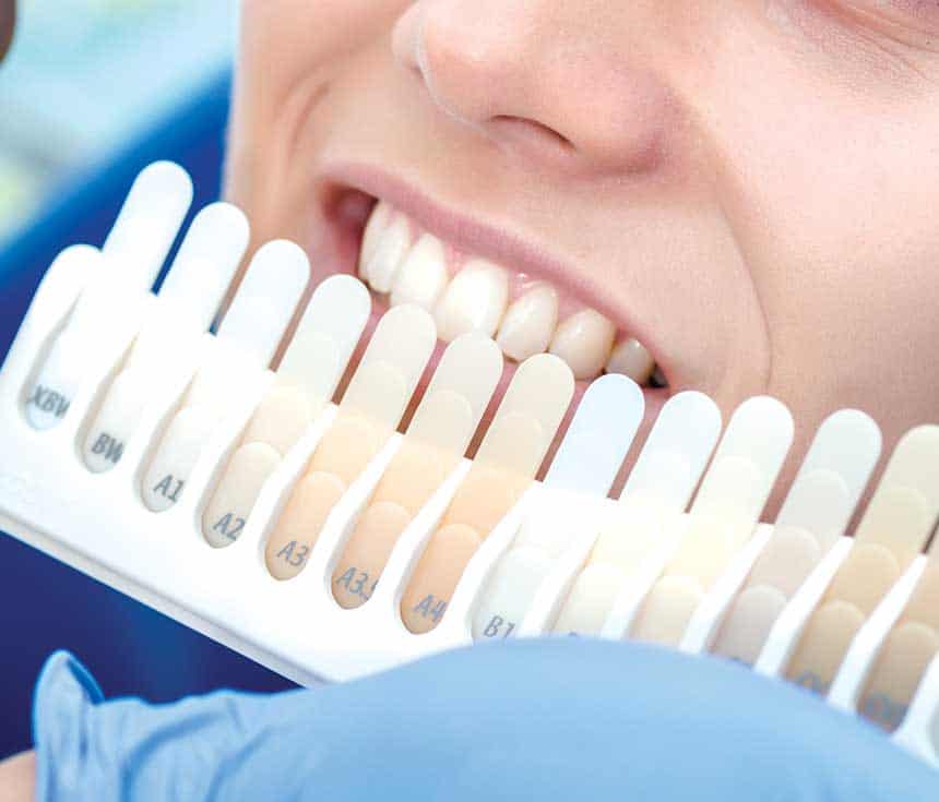 Professional vs At-Home Whitening: What You Need to Know Hemel