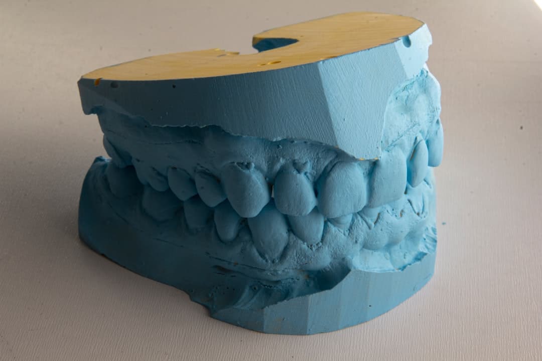 How Do Dental Implants Improve Jawbone Health and Oral Function Hemel?