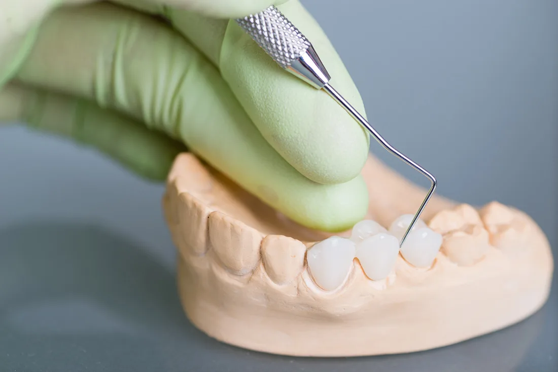 What Are the Different Types of Dental Crowns Available Hemel?