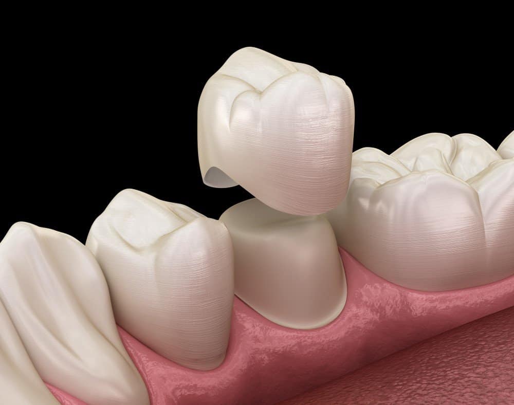 Teeth Whitening: Separating Facts from Fiction Hemel