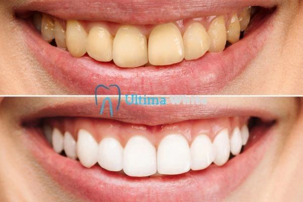Oral Care Tips for Current and Former Smokers Hemel