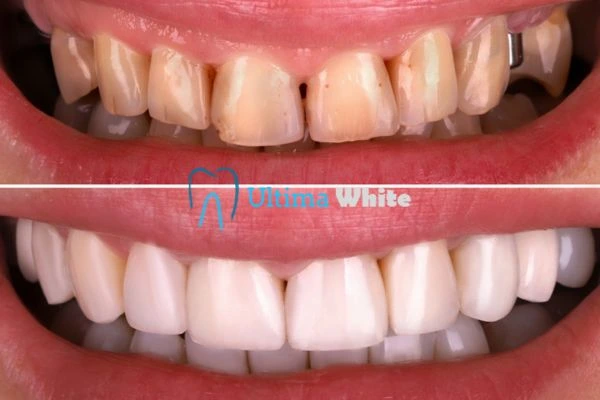 What Makes Instant Teeth Whitening Treatments So Popular Hemel?