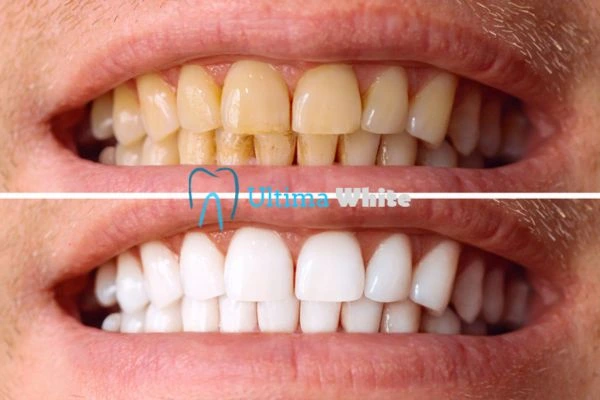 Stained Teeth and Persistent Bad Breath Hemel