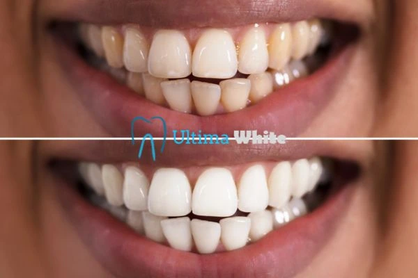 Aftercare Tips to Maintain Your New Smile Hemel